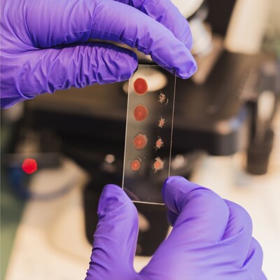 Dry Blood (Oxidative Stress Test)